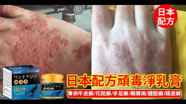 日本配方頑毒凈乳膏 - Image 4