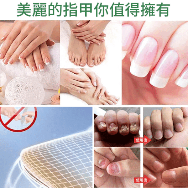 【無痛不復發】灰指甲膏 - Image 2