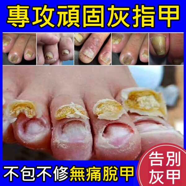 【無痛不復發】灰指甲膏 - Image 3