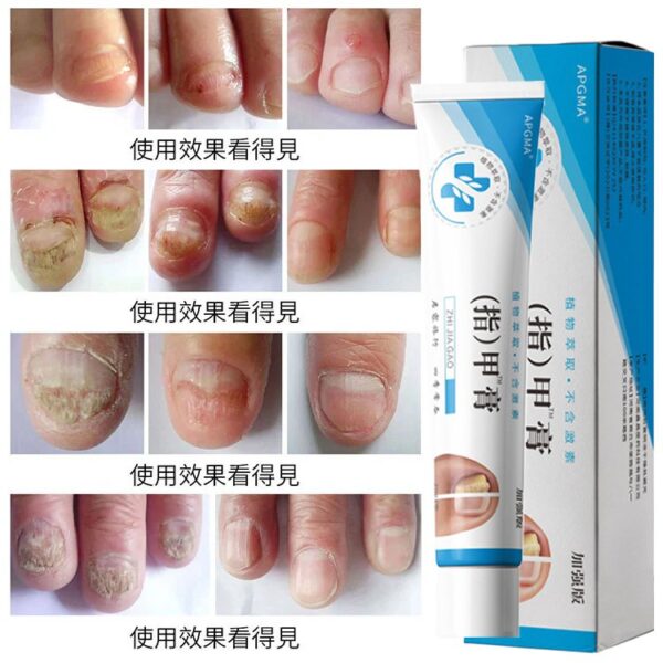 【無痛不復發】灰指甲膏 - Image 6